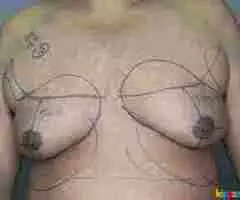 Best gynecomastia surgery in hyderabad - Image 2