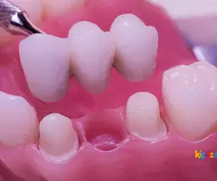 Teeth whitening cost in chennai