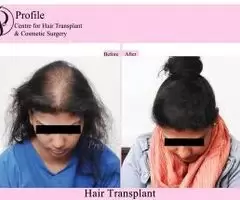 Profile Forte Hair Transplant | Best Centre for Hair Transplant - Image 2