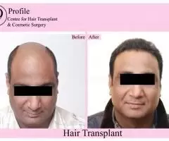 Profile Forte Hair Transplant | Best Centre for Hair Transplant - Image 3